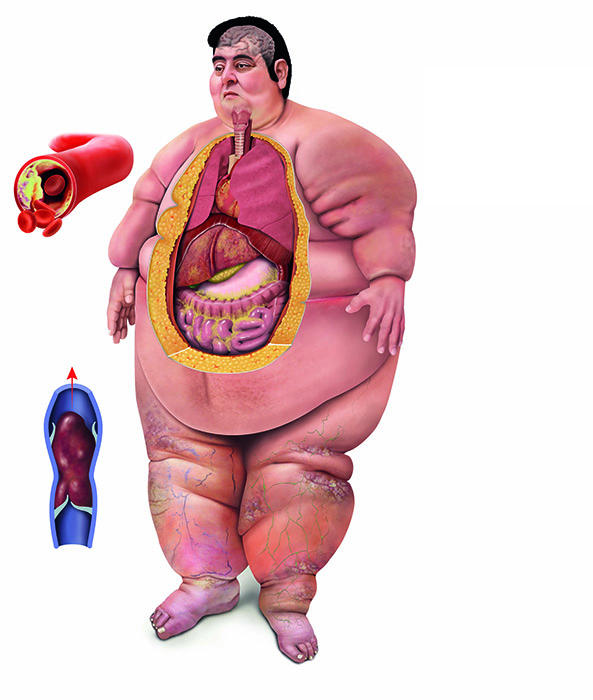 Illustration of obese human