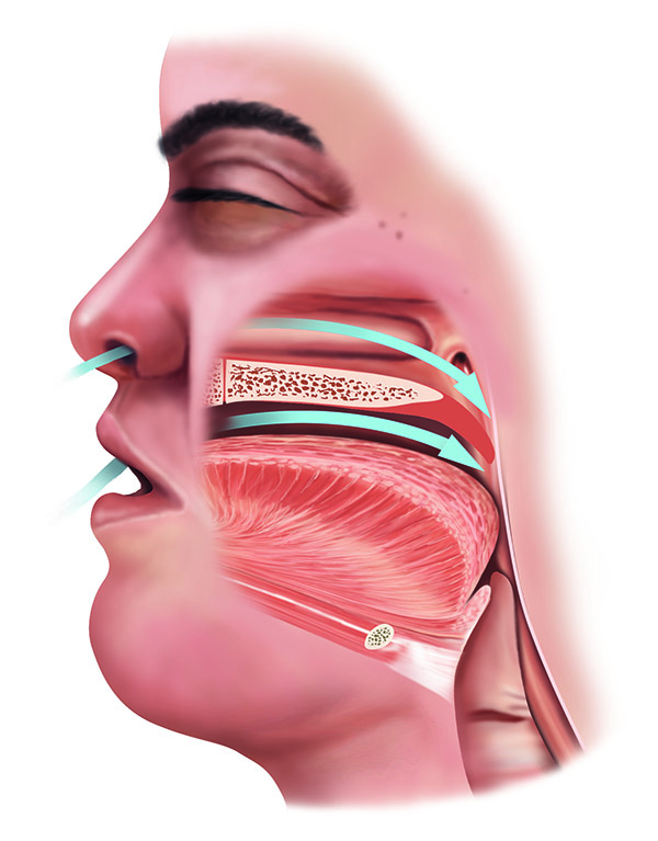 Apnea illustration
